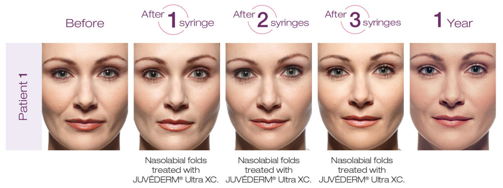 Juvederm before and after