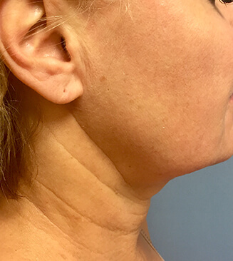 KYBELLA® after