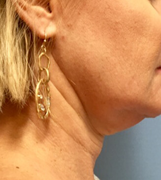 KYBELLA® before