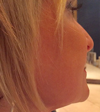 KYBELLA® after