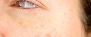 sun spots on face