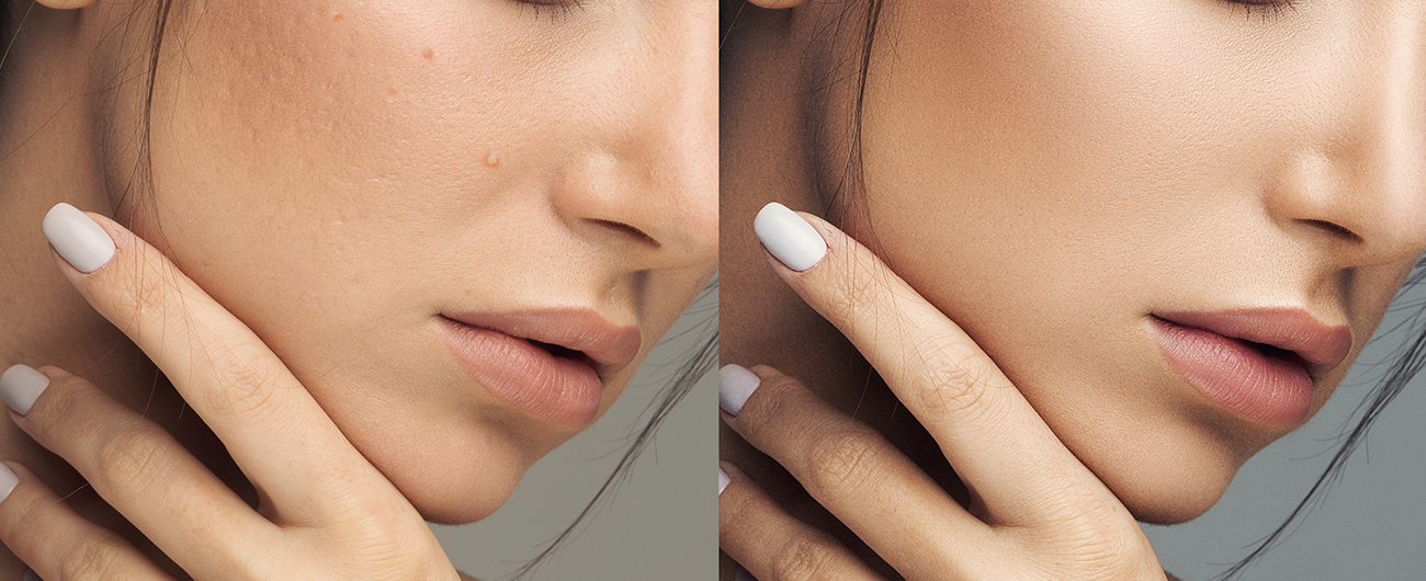 microneedling before and after