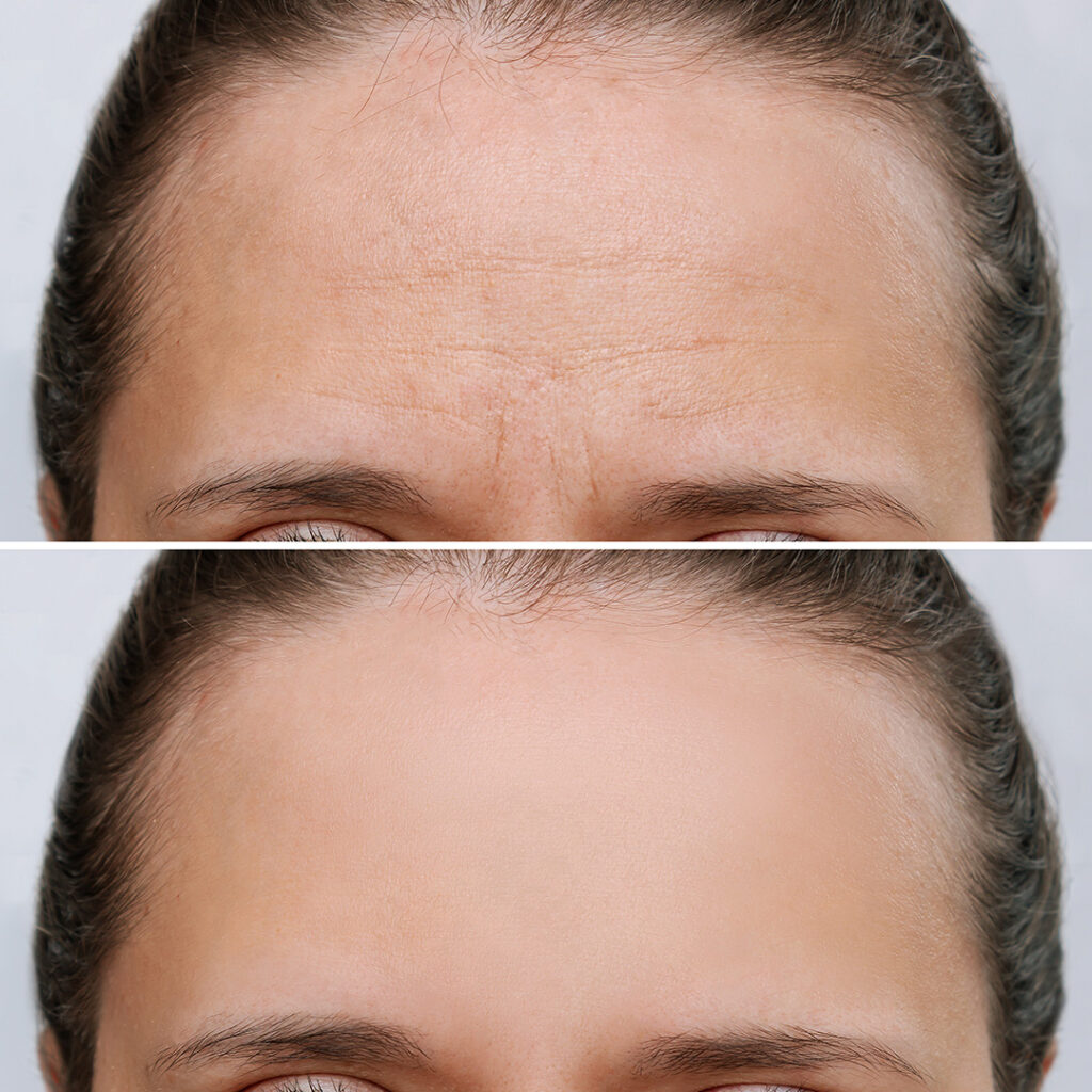 Botox Frown Line Before and After Example