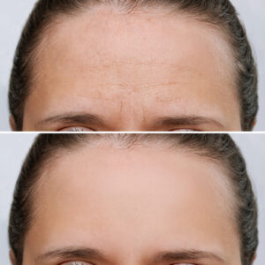 Botox Frown Line Before and After Example