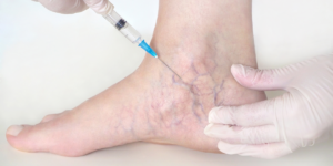 Sclerotherapy Treatment