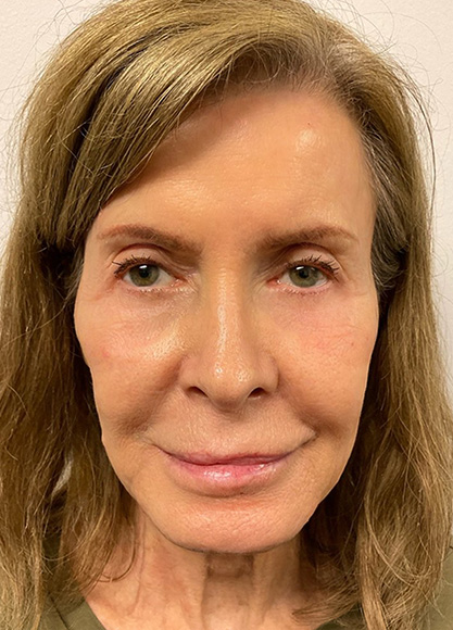 Case 17 Botox and IPL Treatment