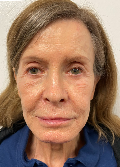 Case 17 Botox and IPL Treatment